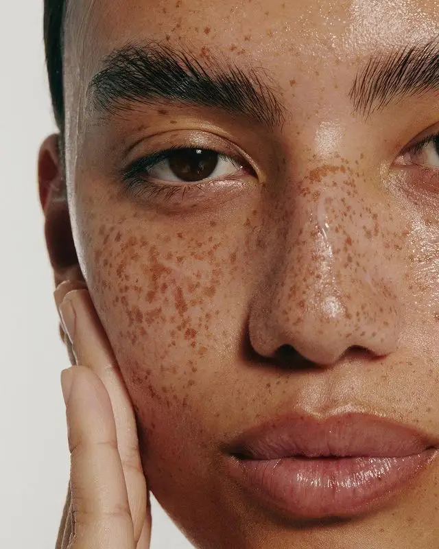 Close-up of a face with dense freckling across the cheeks and nose, one hand resting against the cheek